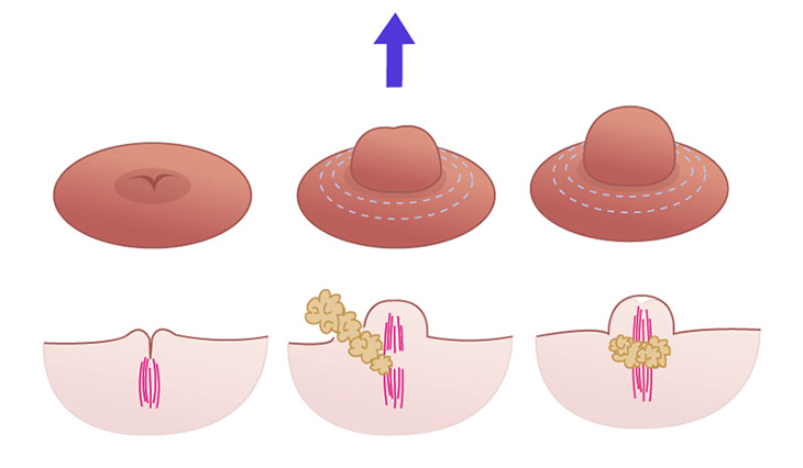 1. Phẫu thuật núm vú là gì?