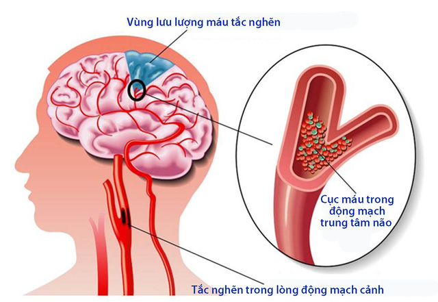 Tai Biến Mạch Máu Não Là Gì? Triệu Chứng, Nguyên Nhân Và Cách Phòng Ngừa Hiệu Quả