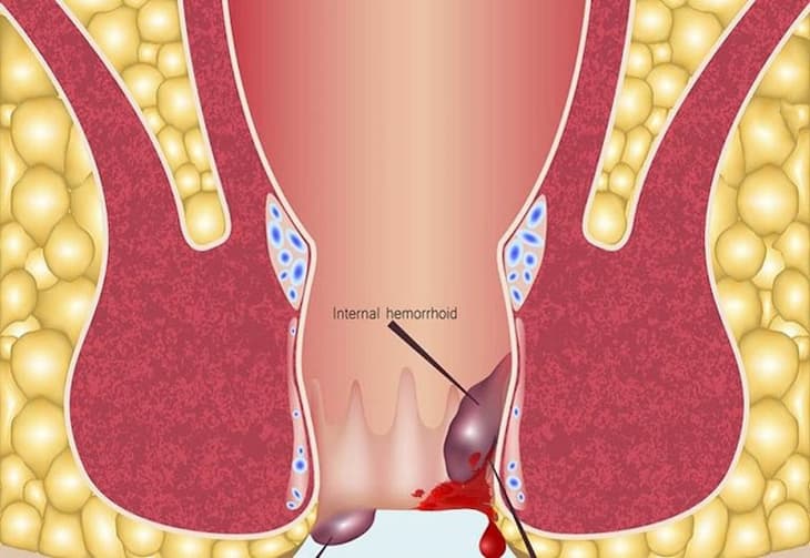 Phòng ngừa trĩ ngoại huyết khối