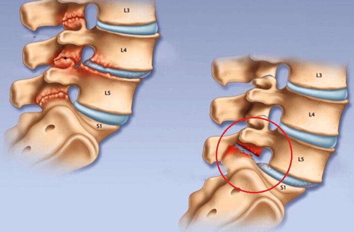Trượt đốt sống thắt lưng: nguyên nhân, triệu chứng và cách điều trị