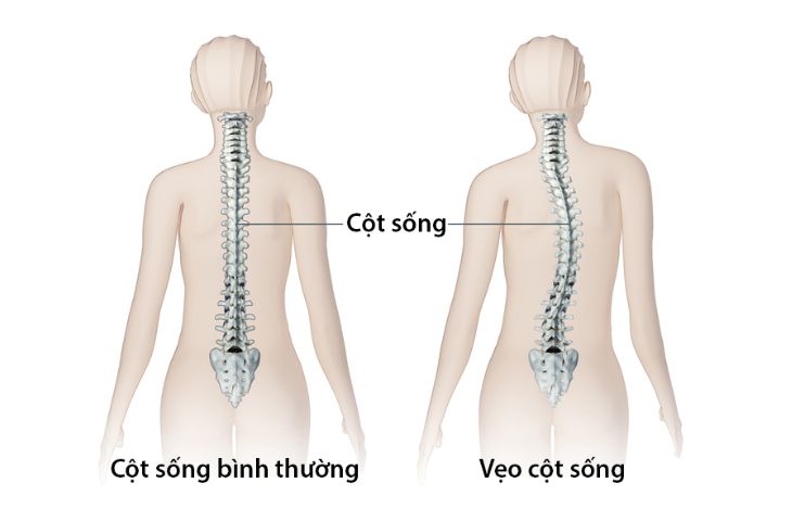 4. Biến chứng của vẹo cột sống