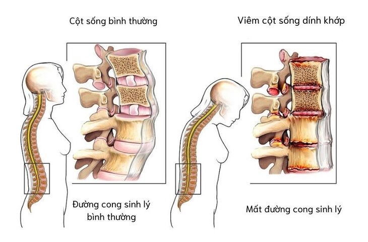 4. Biến Chứng của Viêm Khớp Cột Sống