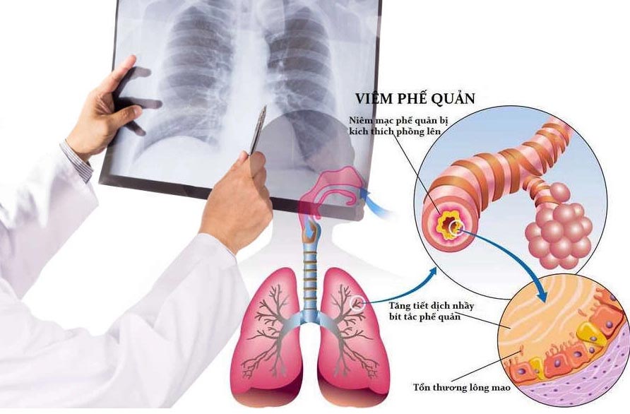 4. Phòng ngừa bệnh viêm phổi