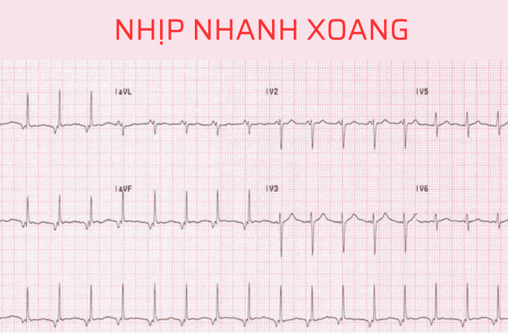 Nhịp Tim Xoang Là Gì?