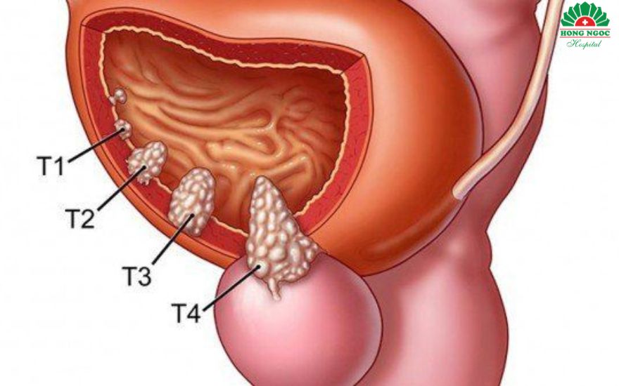 Ung thư tuyên tiền liệt có chữa được không