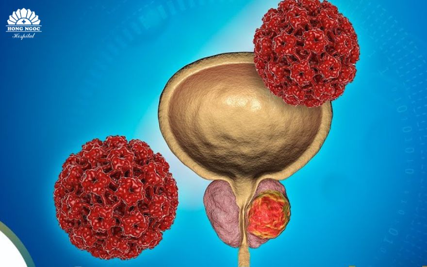 Ung-thu-tuyen-tien-liet