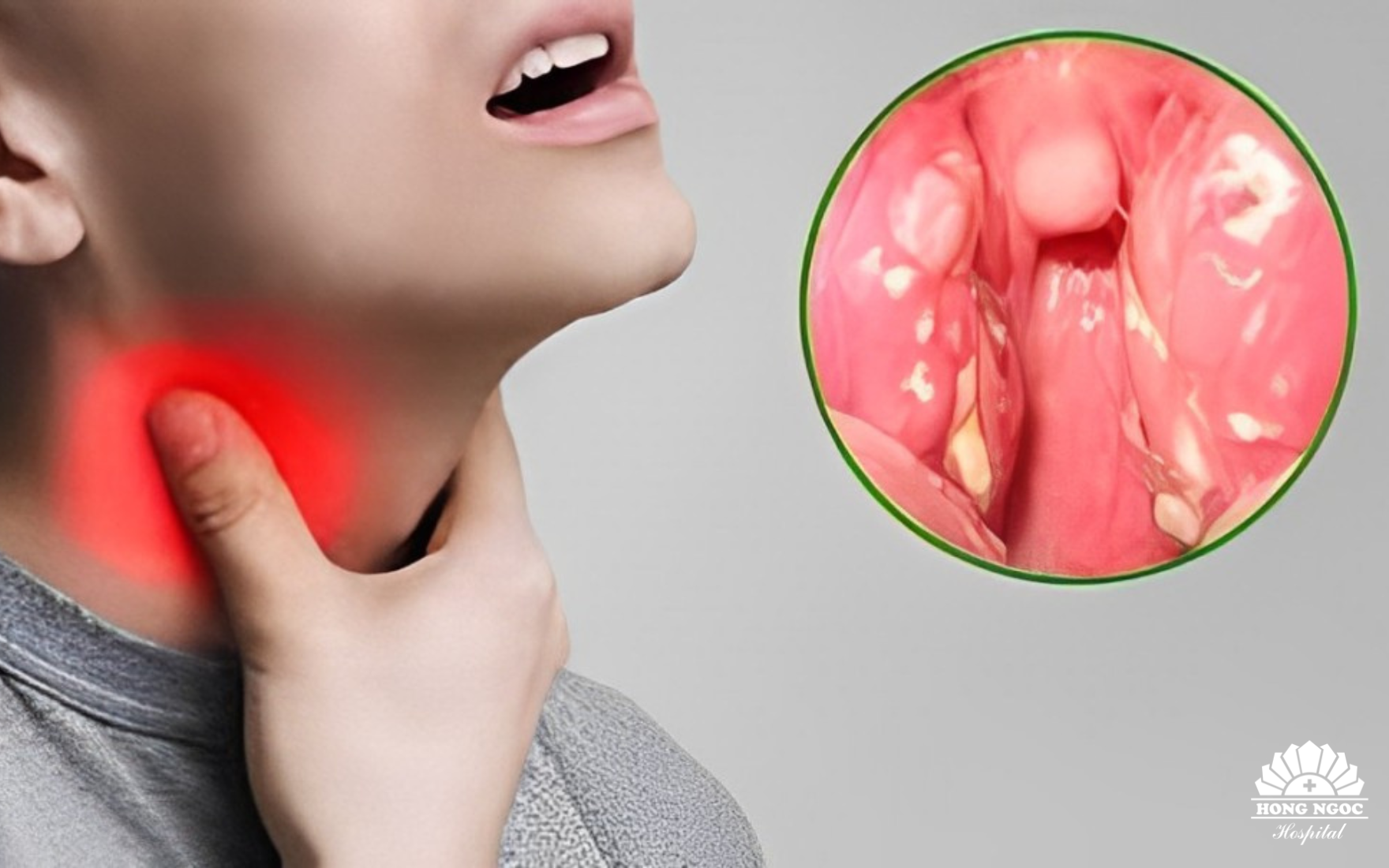 Phân biệt bệnh bạch hầu và viêm họng