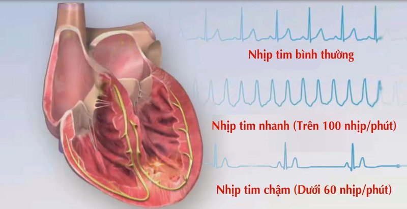 Nhịp tim thấp: Nguyên nhân, triệu chứng và cách điều trị