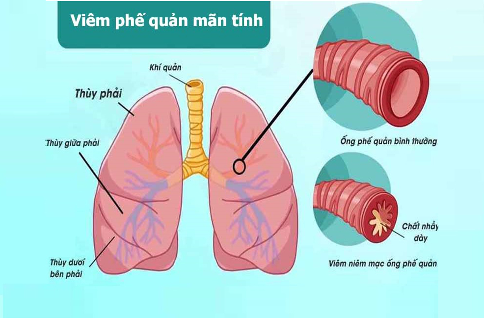 Viêm phế quản mãn tính có chữa được không? Hiểu rõ để điều trị hiệu quả