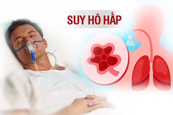 Suy hô hấp là bệnh gì? Nguyên nhân, triệu chứng và cách phòng ngừa