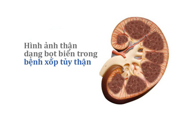 Xốp Tủy Thận: Nguyên Nhân, Triệu Chứng và Điều Trị Hiệu Quả