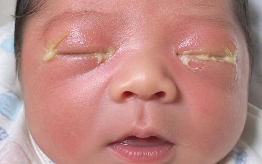 Nếu mắt bé có biểu hiện sưng đỏ và tiết nhiều mủ đặc, hãy lập tức đưa trẻ đến bác sĩ Nhãn khoa.