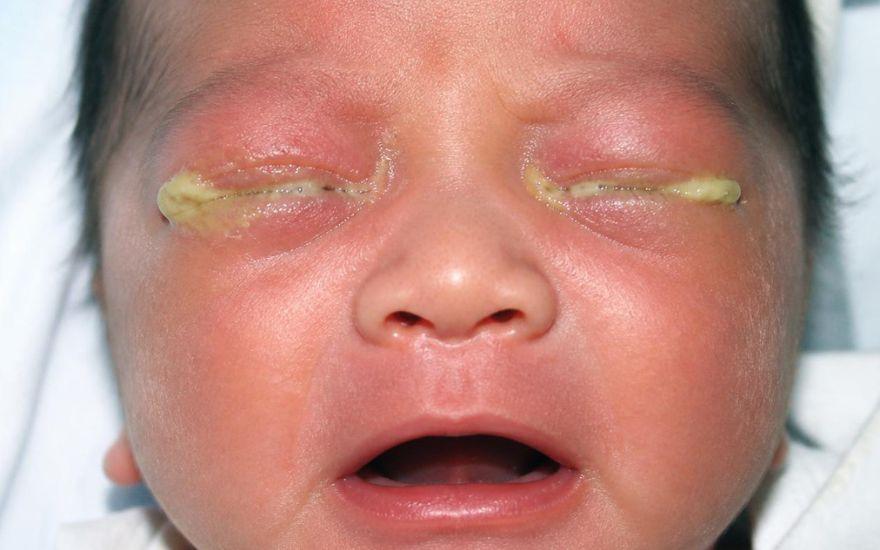 Viêm kết mạc do lậu cầu là một bệnh lý truyền nhiễm cực kỳ nguy hiểm, có thể cướp đi ánh sáng của trẻ.