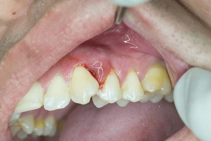 Áp-xe răng miệng ở trẻ có nguy hiểm?