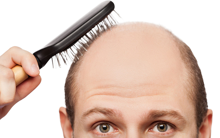 Điểm mặt những bệnh của tóc thường gặp