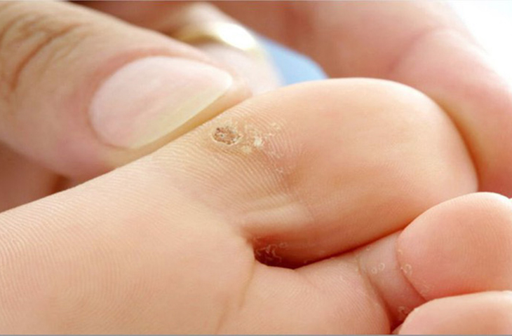 Hạt cơm  bệnh ngoài da thường gặp và cách điều trị
