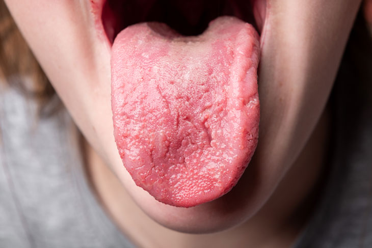 7 loại bệnh về lưỡi thường gặp