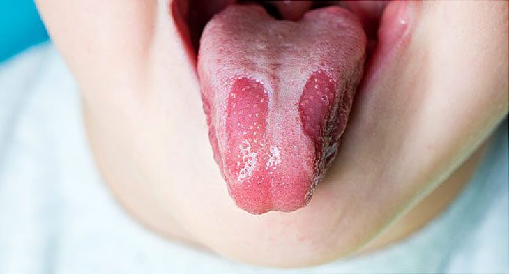 7 loại bệnh về lưỡi thường gặp