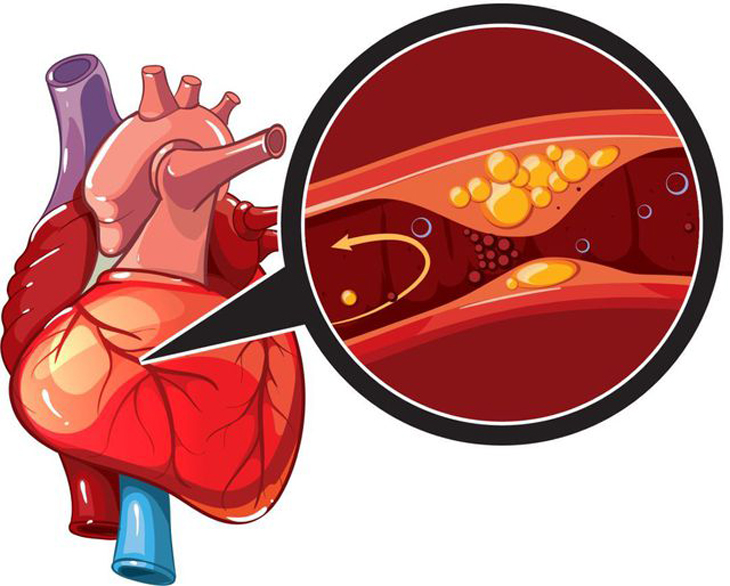Thuốc gì được sử dụng để giảm cholesterol trong điều trị bệnh mạch vành?
