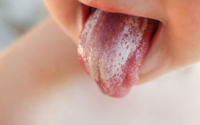 bệnh nấm lưỡi ở trẻ