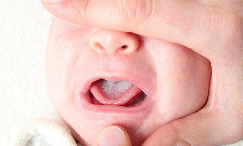 Cách nào trị tưa lưỡi cho trẻ?