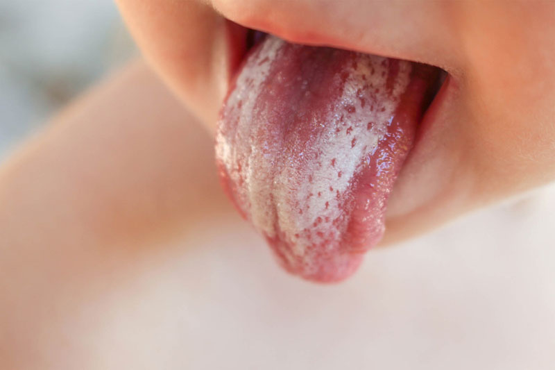 Thuốc điều trị nấm lưỡi cho trẻ em