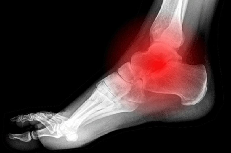 Chấn thương khớp cổ chân và 10 điều cần phải biết