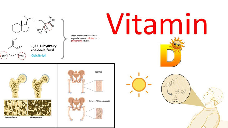 Còi xương ở trẻ do thiếu vitamin D