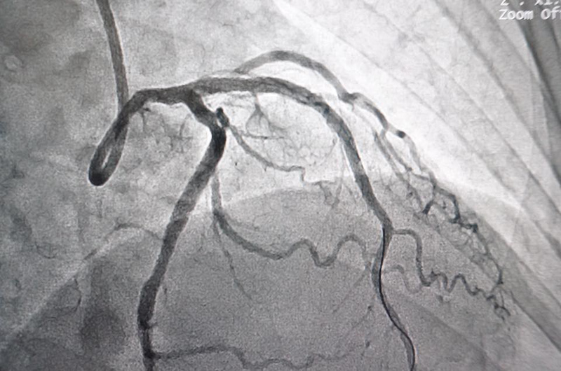 Cơn đau thắt ngực: Cảnh báo bệnh lý tim mạch nguy hiểm