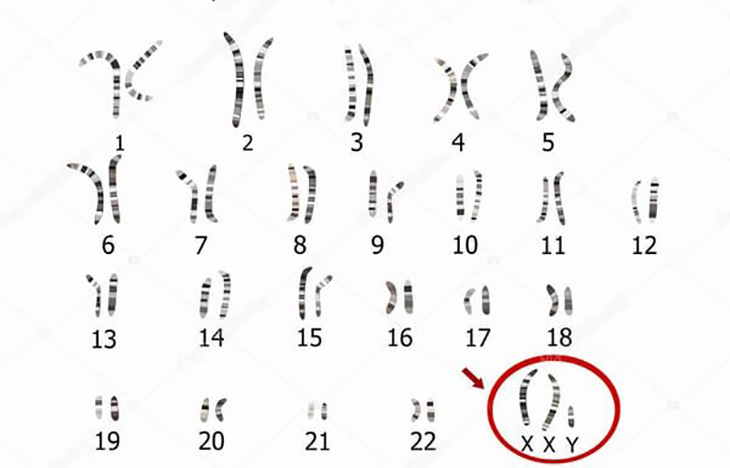 Tìm hiểu về hội chứng Down