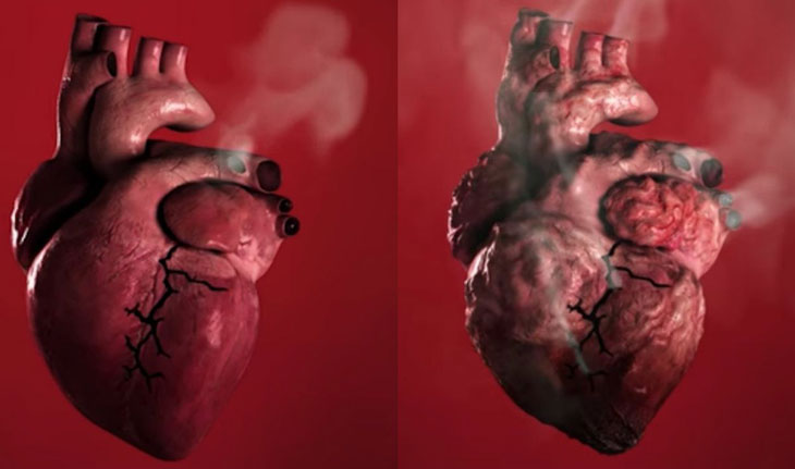 Hút thuốc – Nguy cơ tăng huyết áp và bệnh lý tim mạch