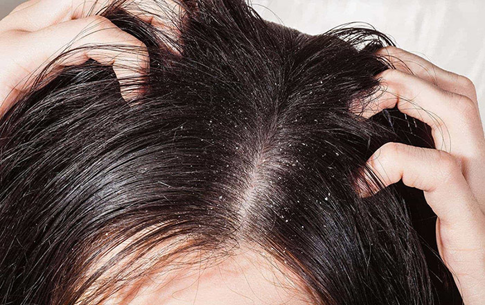 7 cách trị da đầu dầu giúp giảm nhờn cho tóc suôn mượt bất chấp nắng nóng   Hello Bacsi