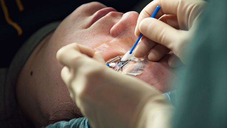 Phẫu thuật lasik chữa cận thị