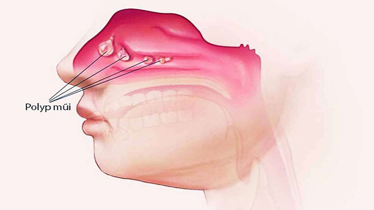 Các biến chứng có thể xảy ra do viêm mũi xoang mạn tính có polyp?
