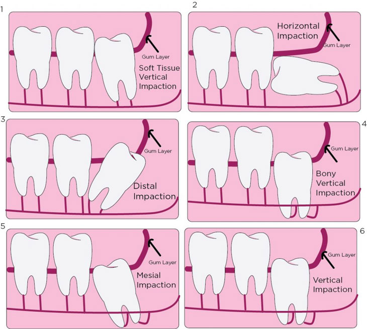 Khi nào cần nhổ răng khôn? Ảnh hưởng của răng khôn mọc lệch