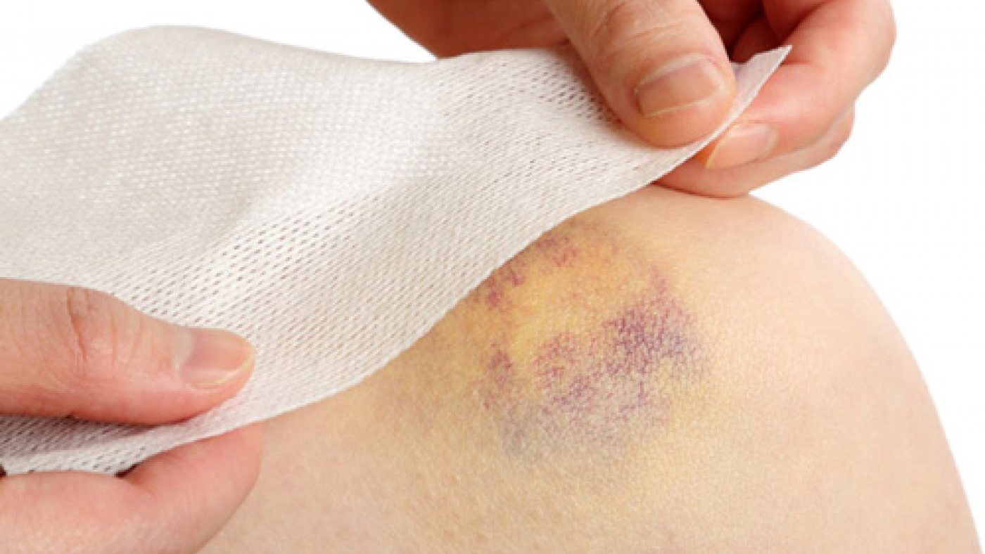 8 nguyên nhân dẫn đến vết bầm tím trên da
