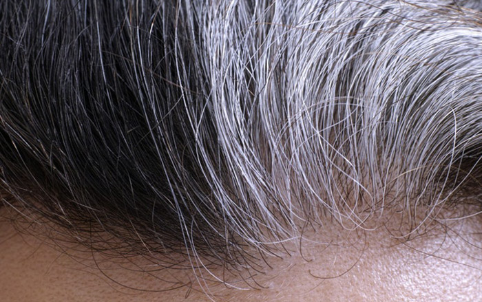 tóc bạc sớm