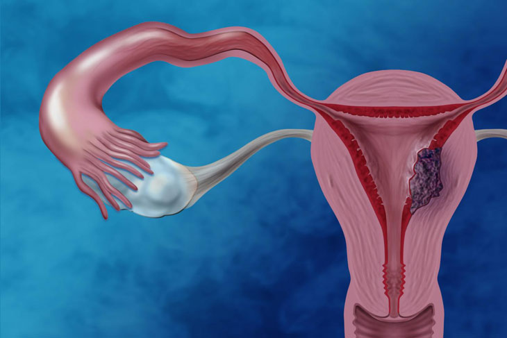 Bệnh u nang buồng trứng: Nguyên nhân và cách chữa trị