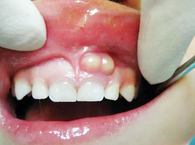 U nang răng có nguy hiểm không? Cách khắc phục