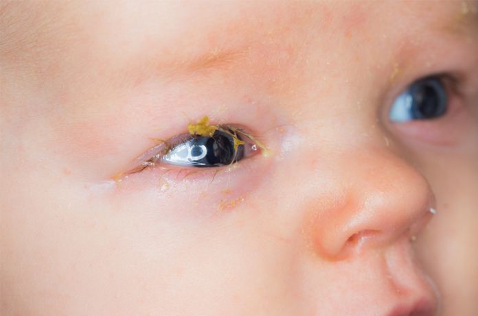 Vệ sinh mắt cho trẻ sơ sinh và 3 lưu ý quan trọng