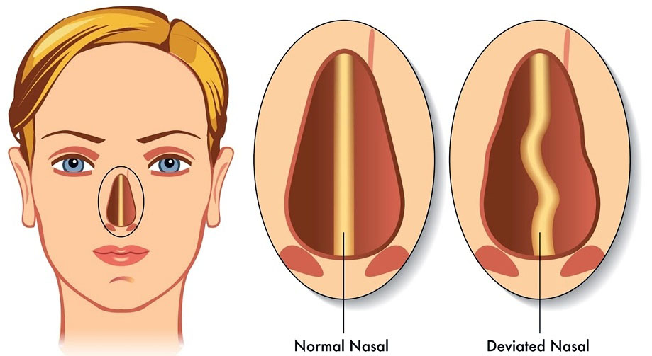 Tiến trình điều trị vẹo vách ngăn mũi như thế nào để giảm triệu chứng viêm xoang?
