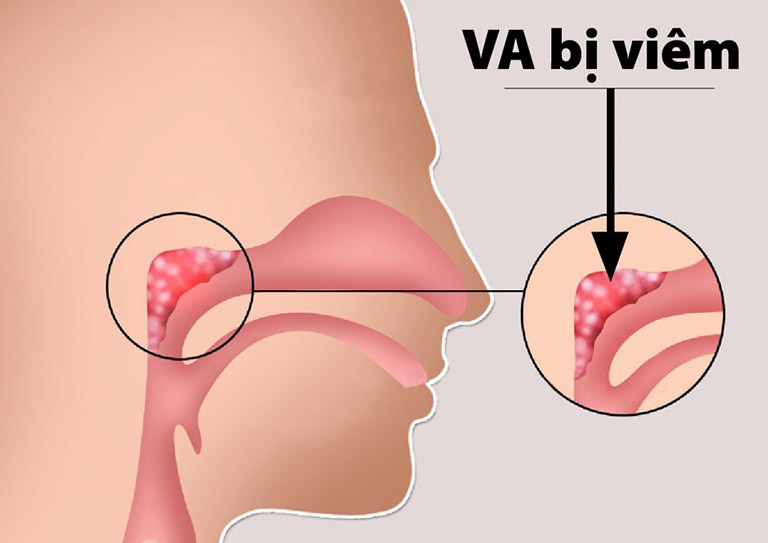 Viêm VA ở trẻ: Biểu hiện, biến chứng và phương pháp điều trị