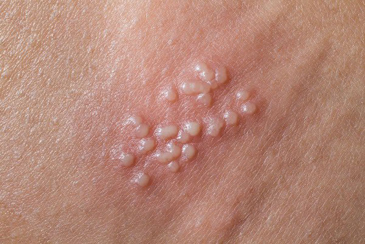 Herpes sinh dục có nguy hiểm không?
