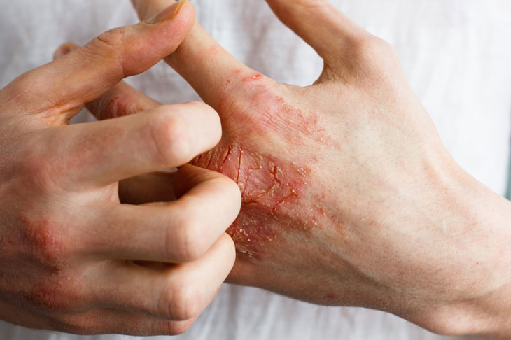 Nếu không được điều trị, nhiễm trùng da có mủ có thể gây ra những biến chứng gì?
