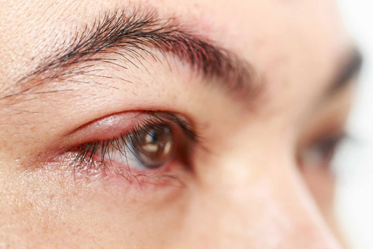 Ngoài viêm kết mạc, có những bệnh lý nào khác liên quan đến mắt mà có thể điều trị bằng cách sử dụng đơn thuốc?