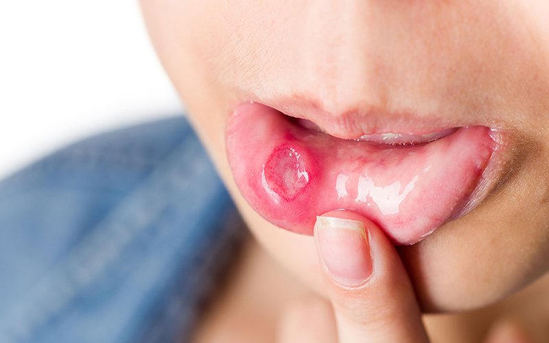Loét niêm mạc miệng – Nguyên nhân, dấu hiệu và phương pháp điều trị