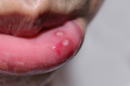 Loét niêm mạc miệng – Nguyên nhân, dấu hiệu và phương pháp điều trị