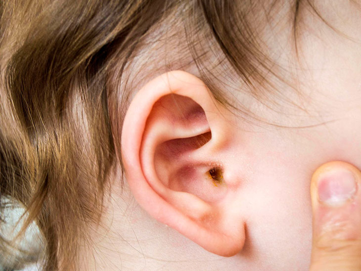 Viêm tai giữa: Chỉ định phẫu thuật khi nào?
