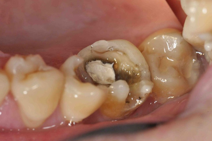 Viêm tủy xương hàm do sâu răng?