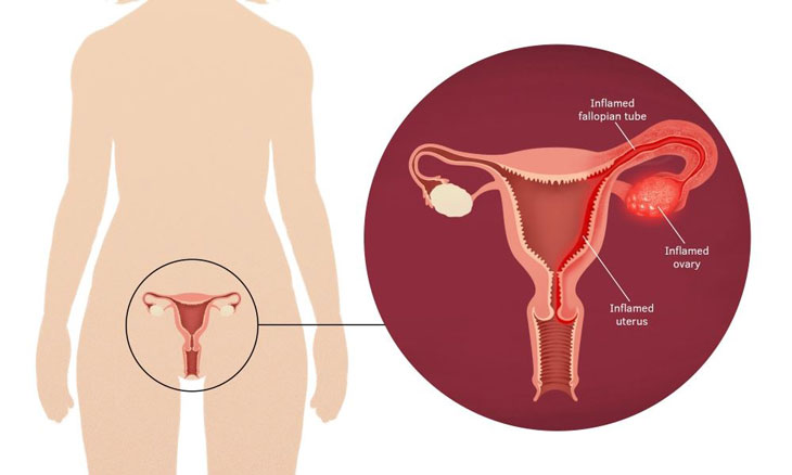 Các biện pháp điều trị hiệu quả cho viêm xương chậu ở nữ giới là gì?
